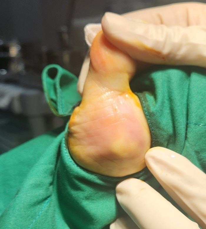 Thought It Was a Corn or Callus — Turned Out to Be a Benign Tumor on the Sole of the Foot