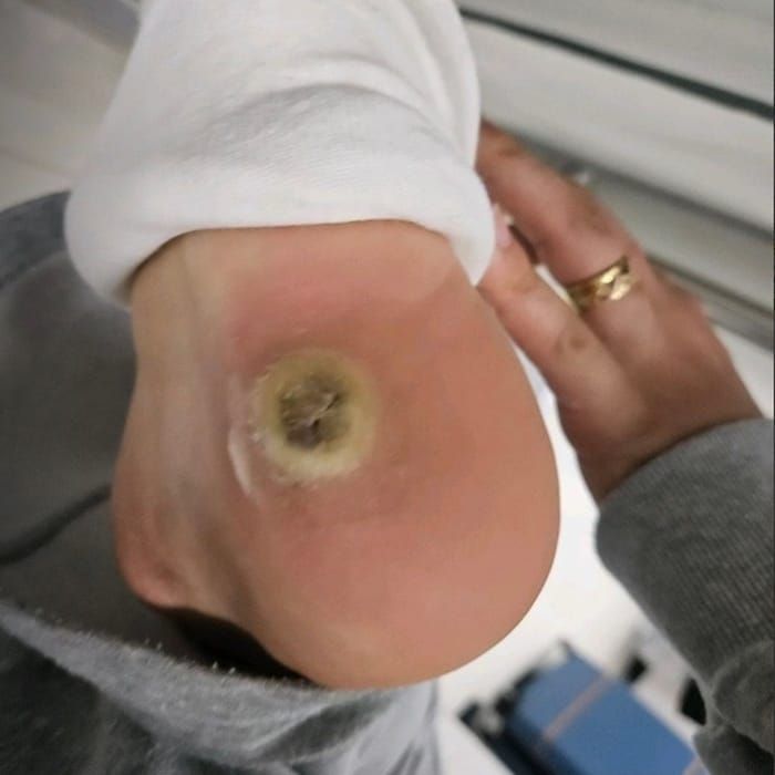 Plantar Corn vs. Wart: What Looked Like a Corn Was Actually a Wart