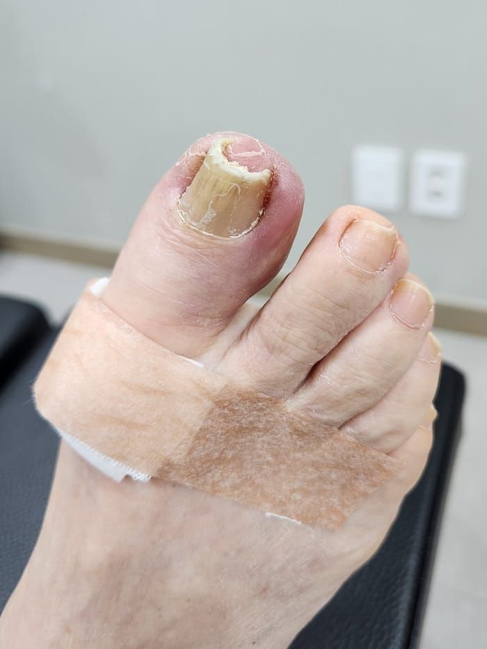Ingrown Toenail Self-Treatment vs. Specialist Care: Why Accurate Diagnosis Matters for Toe Pain Relief