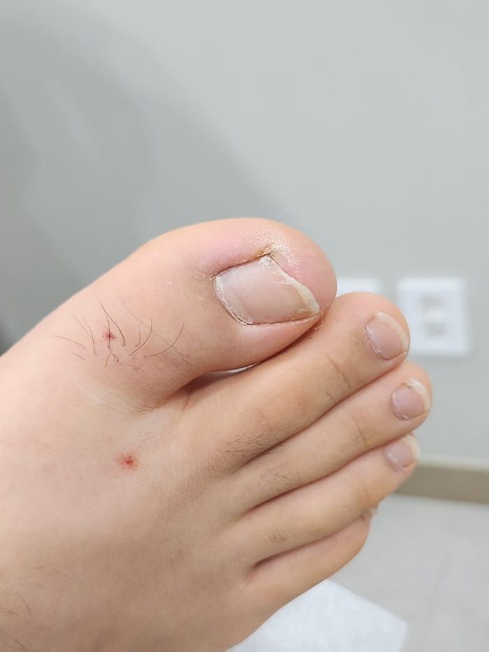 Ingrown Toenail in Children: Why Specialized Orthopedic Care Matters