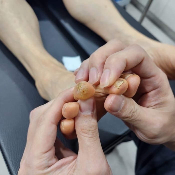 Corn Removal Surgery for Toe Corns and Hammer Toe — Same-Day Procedure After 3 Years of Dermatology Visits