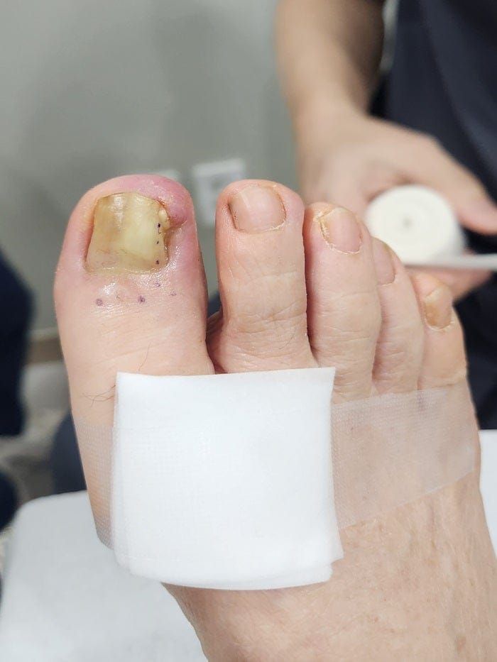 Ingrown Toenail Treatment in Gangnam: Pus, Inflammation, and Nail Deformity Treated Accurately