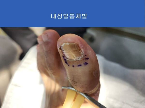 Ingrown Toenail Treatment & Recurrence Specialist | Gangnam Standard Orthopedic Clinic near Gangnam Station