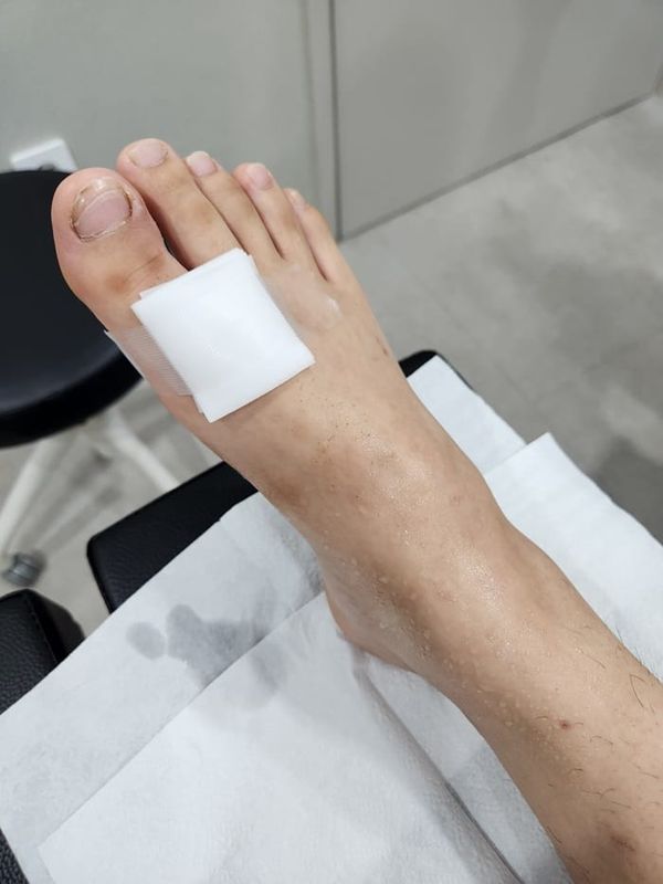 Ingrown Toenail Infection & Surgery | Gangnam Standard Orthopedic Clinic