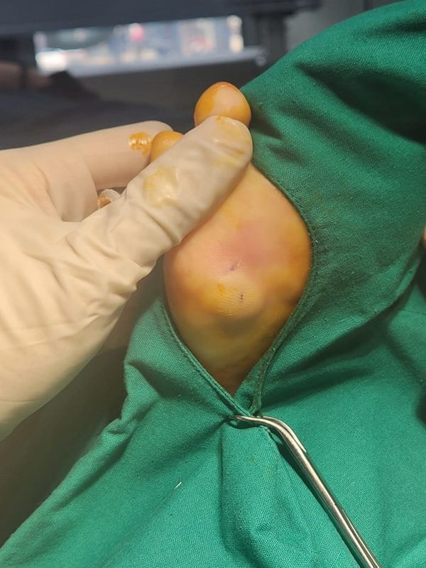 No Improvement from Corn Cryotherapy — Turned Out to Be a Plantar Benign Tumor (Epidermal Cyst)