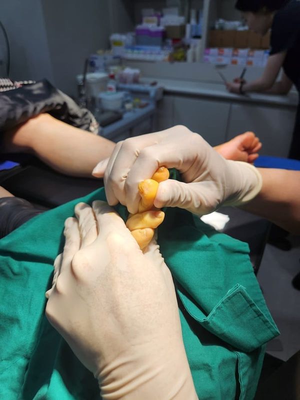 Corn Removal Surgery for Toe Corns and Hammer Toe — Same-Day Procedure After 3 Years of Dermatology Visits