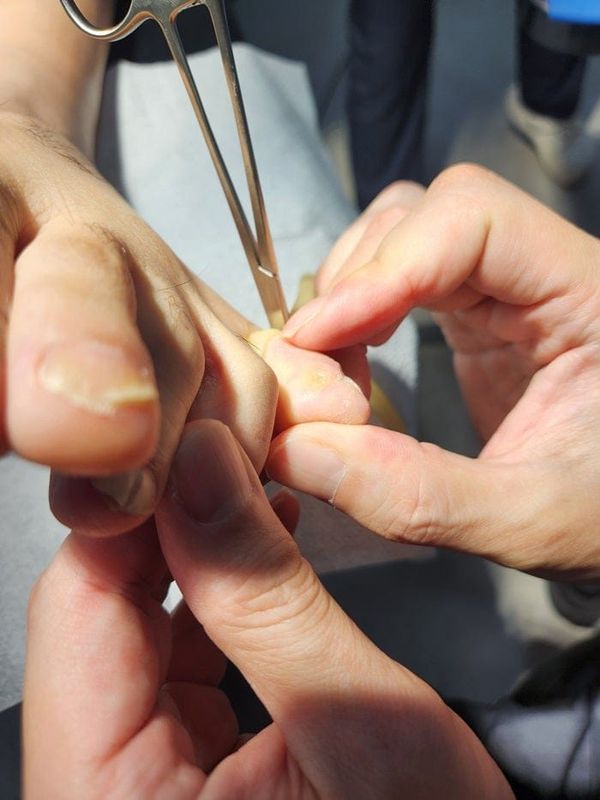 Pinky Toe & Between-Toe Corns and Calluses: Treating the Root Cause at Our Gangnam Orthopedic Clinic