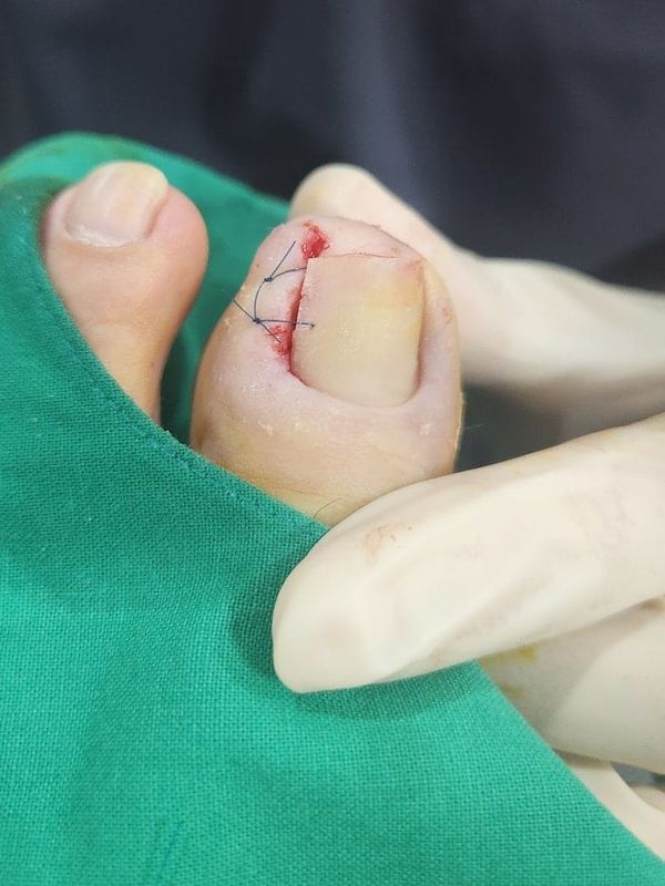 Ingrown Toenail: Causes of Toe Inflammation, Big Toe Pain, and Toenail Pain