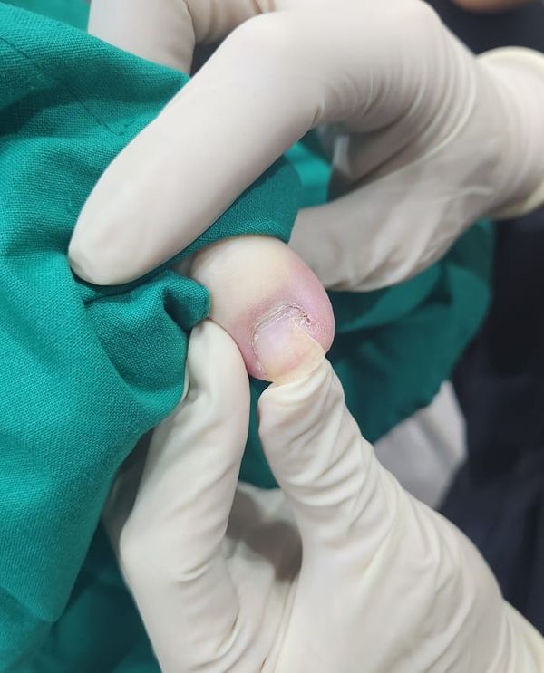Ingrown Toenail Treatment in Gangnam | Big Toe Pain & Infection — Gangnam Standard Orthopedic Clinic