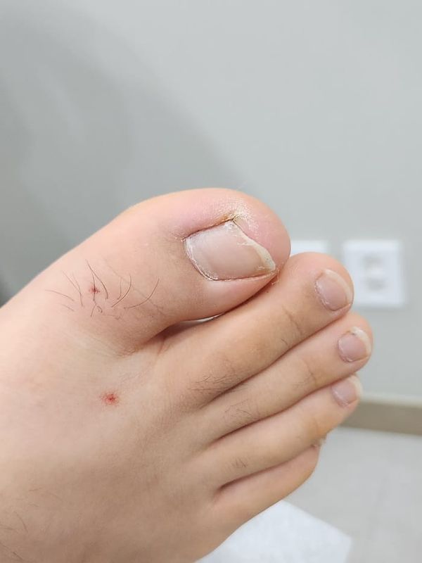 Ingrown Toenail in Children: Why Specialized Orthopedic Care Matters