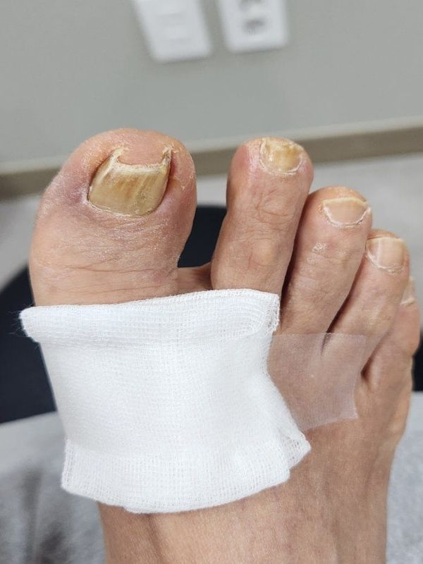 Big Toe Pain and Ingrown Toenail: Why You Should See an Ingrown Toenail Specialist