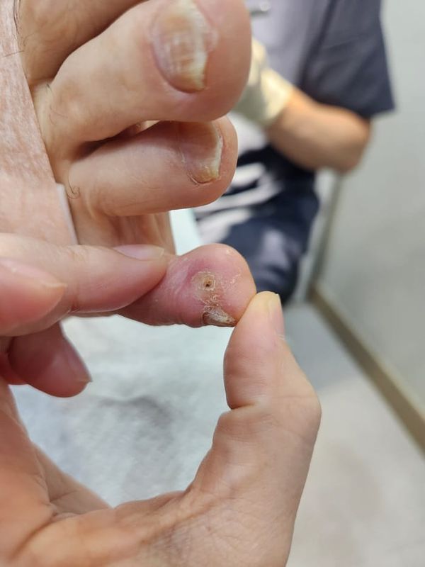 Toe Corns and Calluses on the Little Toe: Treating the Root Cause