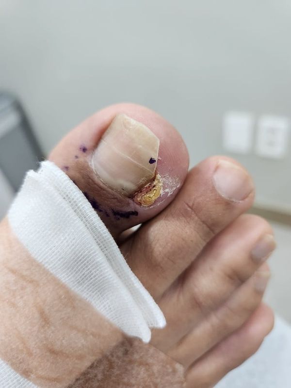 Ingrown Toenail Treatment in Gangnam: Inflammation, Discharge, and Nail Deformity All Addressed
