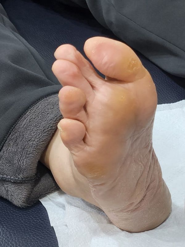 Foot Pain from Plantar Calluses: When to See a Specialist
