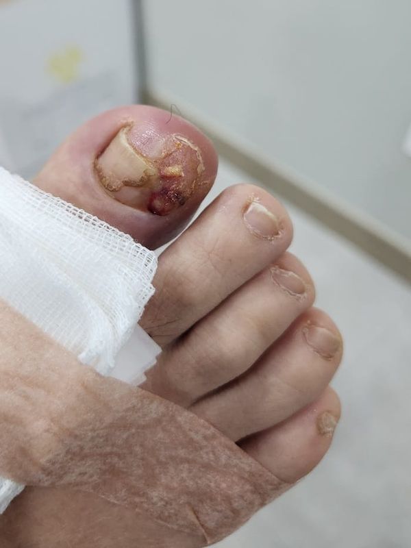 Ingrown Toenail: Causes of Big Toe Pain and Nail Pus Explained
