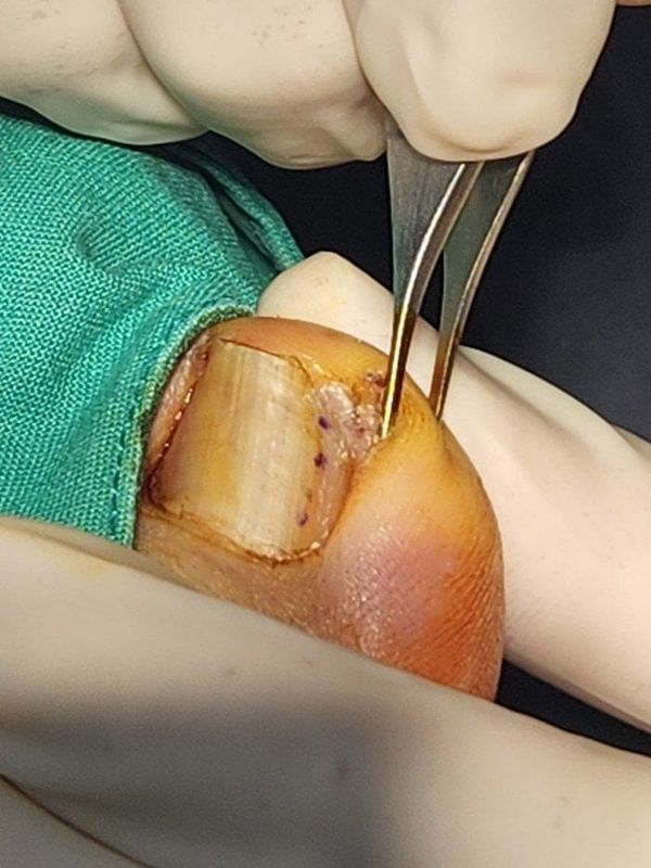 Big Toe Pain and Pus: Could an Ingrown Toenail Be the Cause?