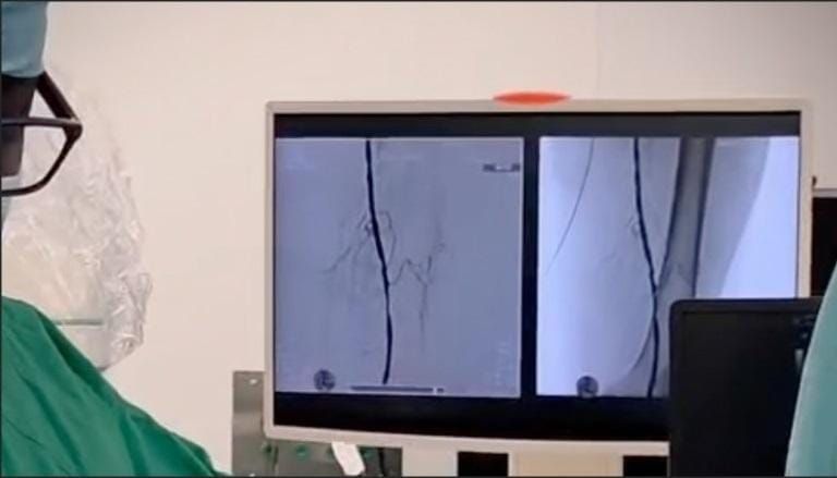 Colón estrena técnica para salvar piernas en Hospital Amador Guerrero
