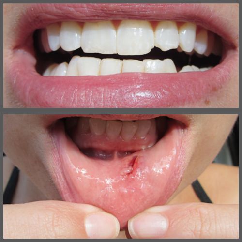busted lip