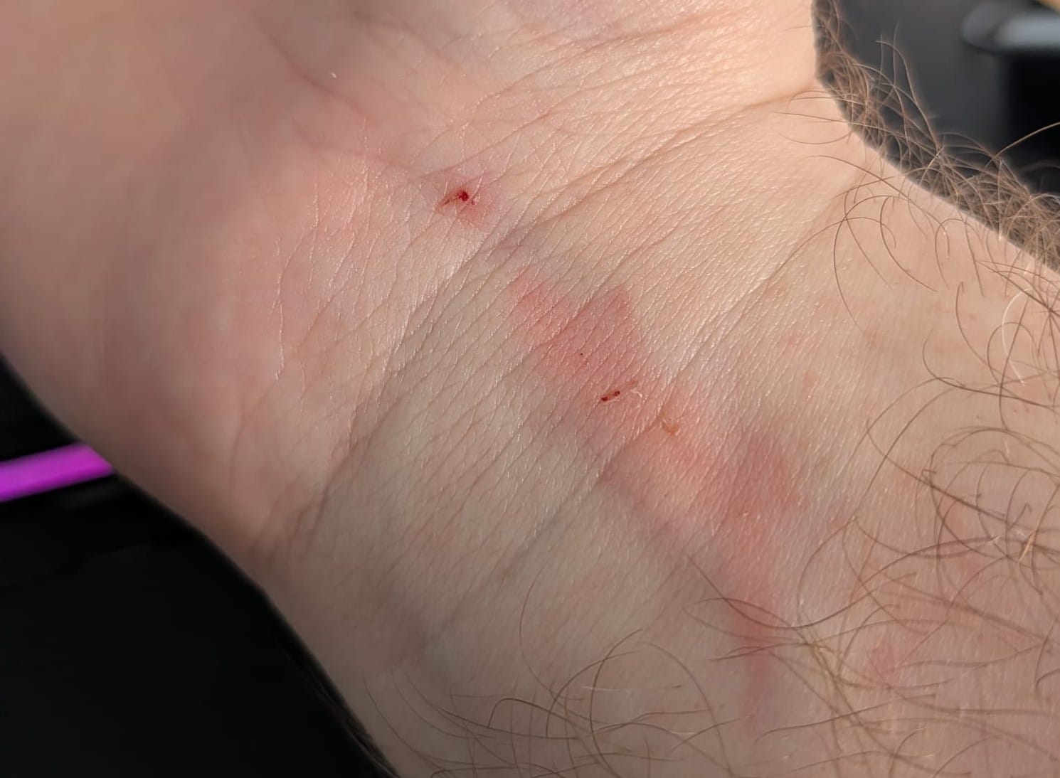 A close up photo of my slightly scraped wrist. 