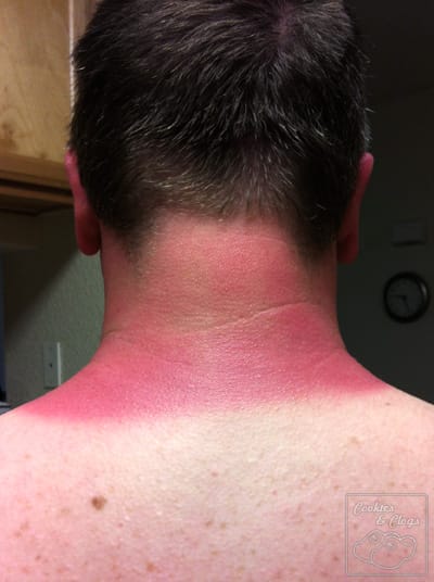 Bad sunburn on neck forgot sunscreen pain