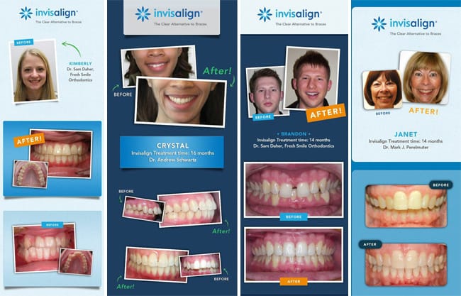 Invisalign vs Braces - Before and After Photos #InvisalignTalk