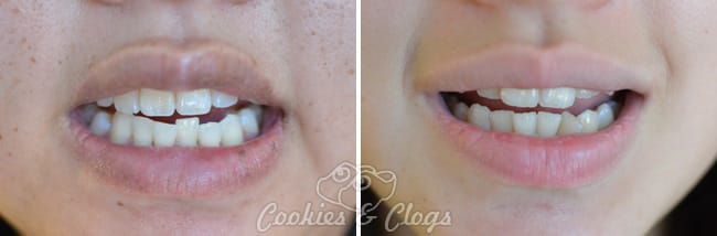 Invisalign vs Braces - Crooked teeth in need of Invisalign #InvisalignTalk