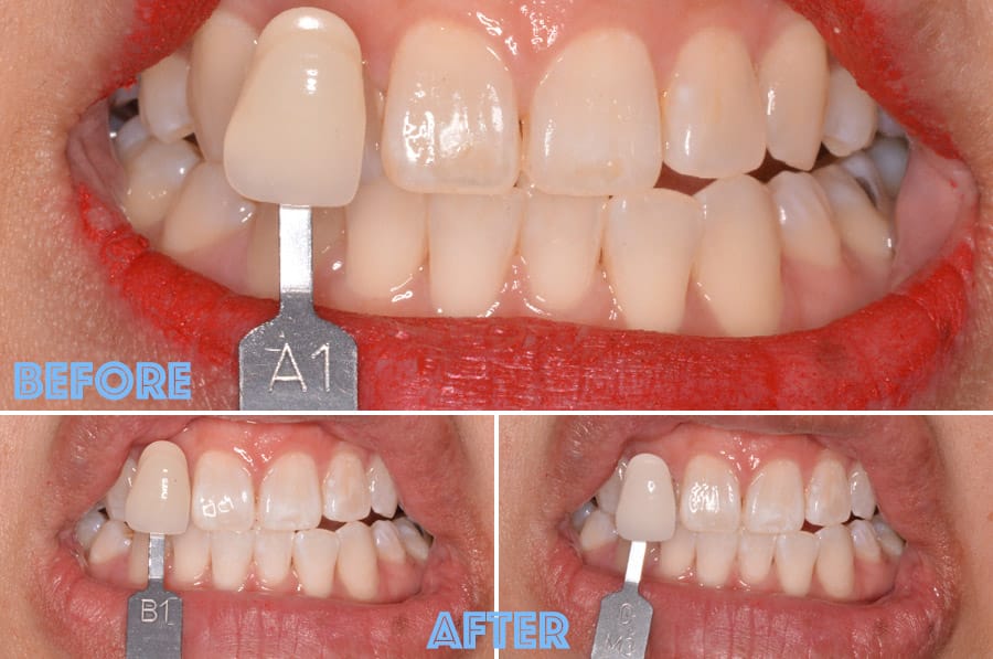 Cookies & Clogs | Dental | Health | Ever wonder what it's like to get Zoom! teeth whitening? Here's what you should know before you get the procedure done. It's key to have a good dental staff like I did at Zoom Dental. See why it was so critial for me including the step-by-step process and before and after photos.
