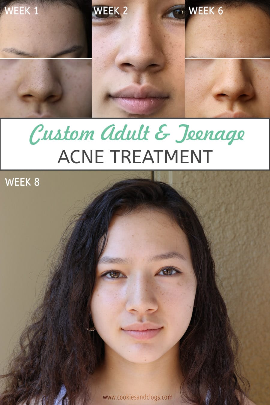 Custom teenage acne treatment w/ Curology