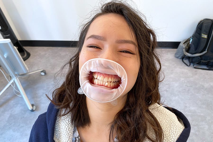 Braces Alternative Clear Aligners with Uniform Teeth San Francisco mouth guard