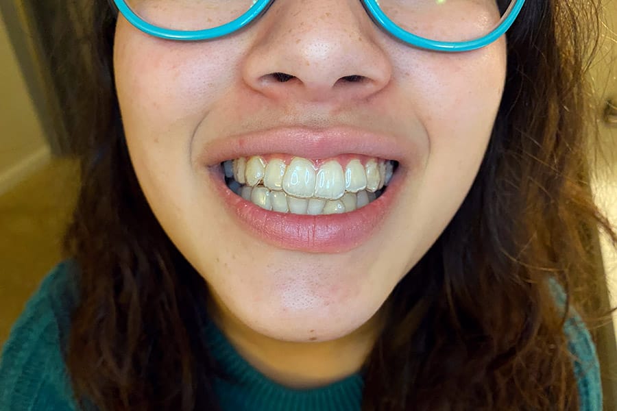 Uniform Teeth Clear Aligners Tray Set and Covid-19 safety updates