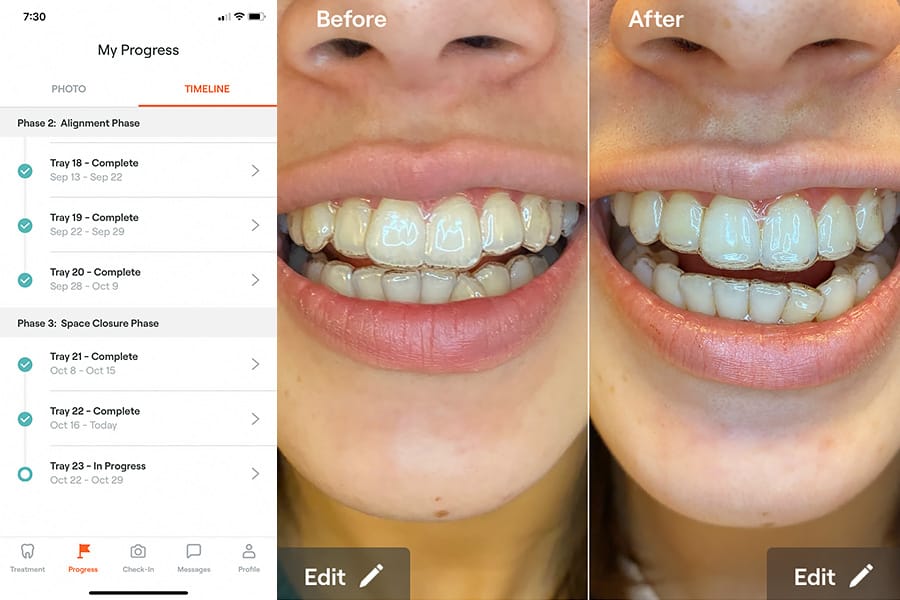 Uniform Teeth Clear Aligner Teeth Straightening Alignment Phase - Tray 23 Update