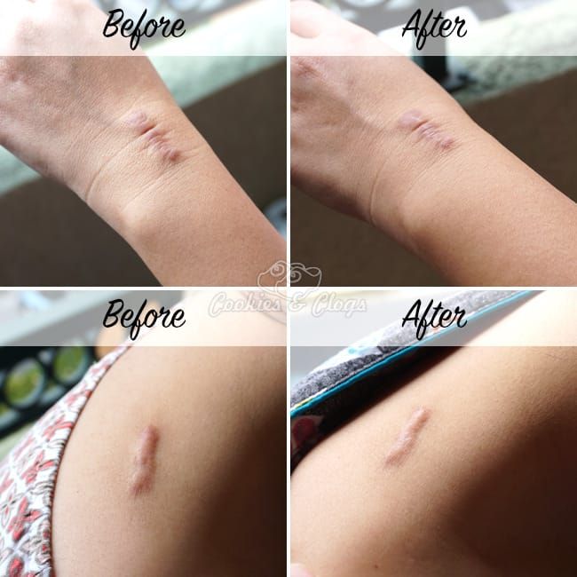 Health | ScarAway Gel helps lessen the appearance of scars and keloids. See how it worked out of me.