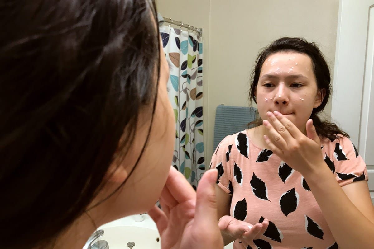 Custom teenage acne treatment w/ Curology - teen putting on cream