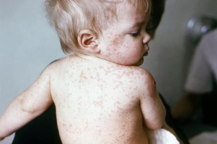 Measles comes to Kentucky: experts discuss what’s next