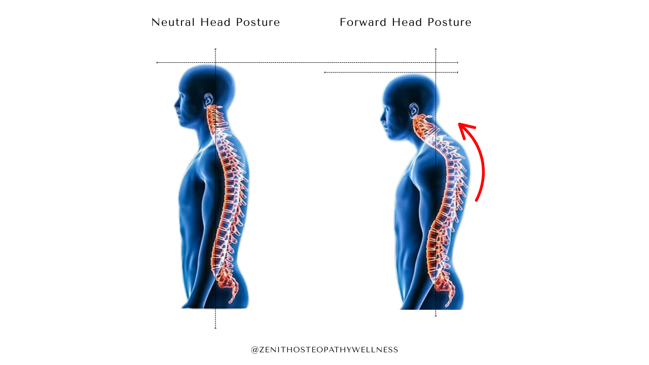 Visual showing hyperkyphosis- an exaggerated curve of the upper back