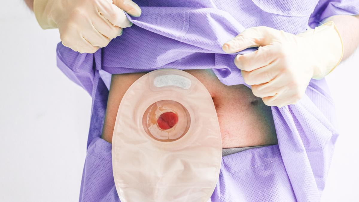 J-Pouch, Stoma, Beuteltier: Was ist das und warum ist es für CED-Patient:innen wichtig?