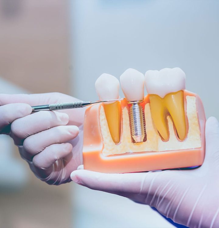 Whole Tooth Column: Behind the scenes of dental implants