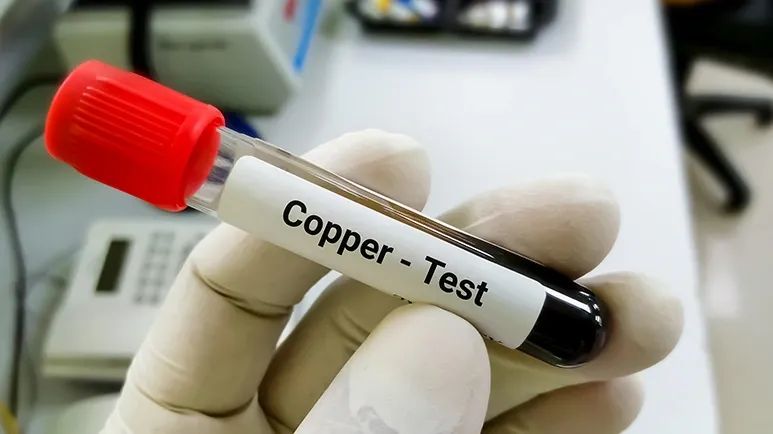 what is copper storage disease