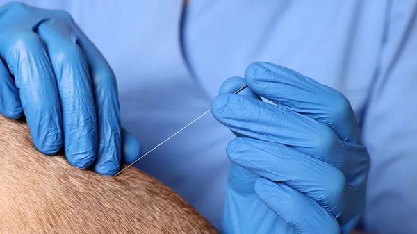 acupuncture healing therapy