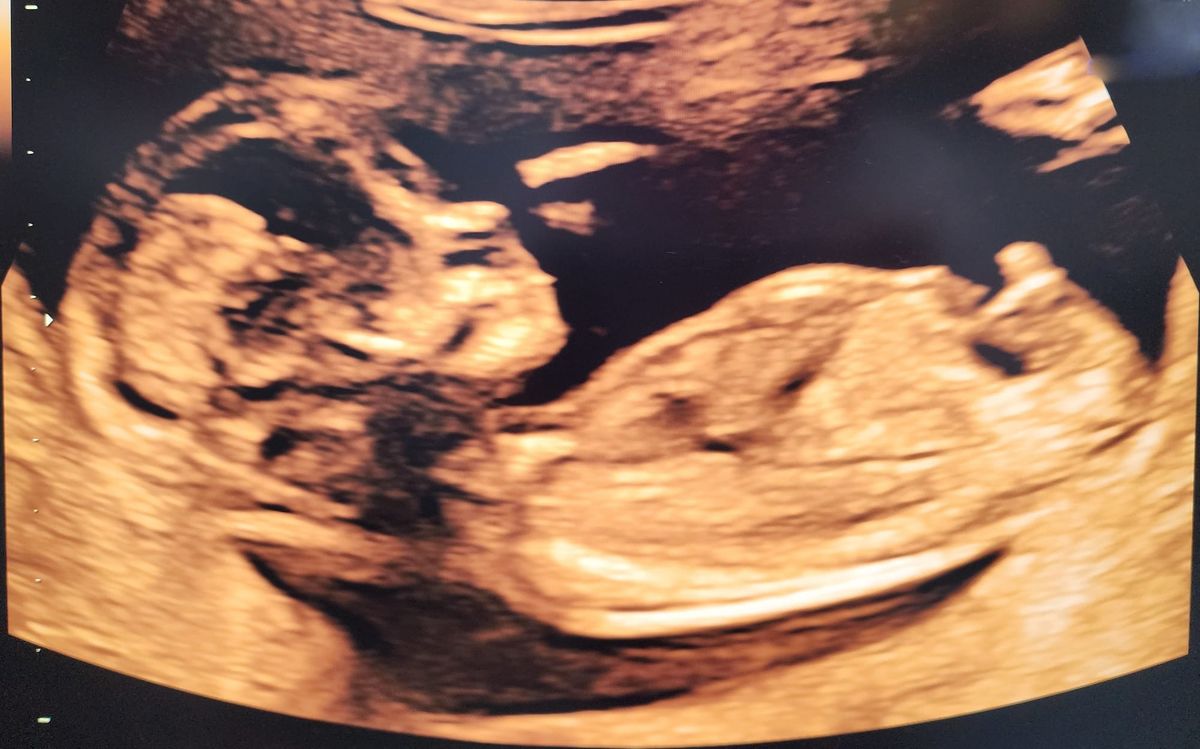 an ultrasound image of a baby