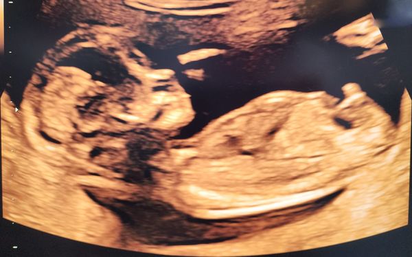 an ultrasound image of a baby