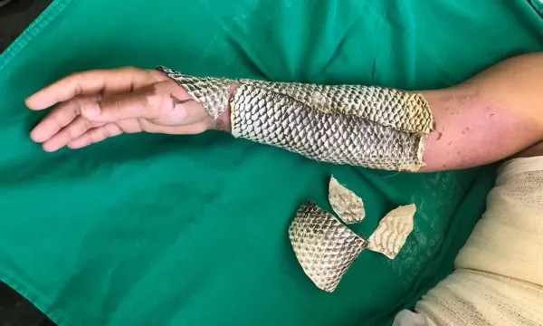 Braço de paciente com queimadura recebendo curativo de pele de tilápia, sobre um tecido cirúrgico verde