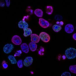 AI reveals a hidden split inside a century-old sign of breast cancer