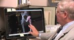 Hip Replacement 