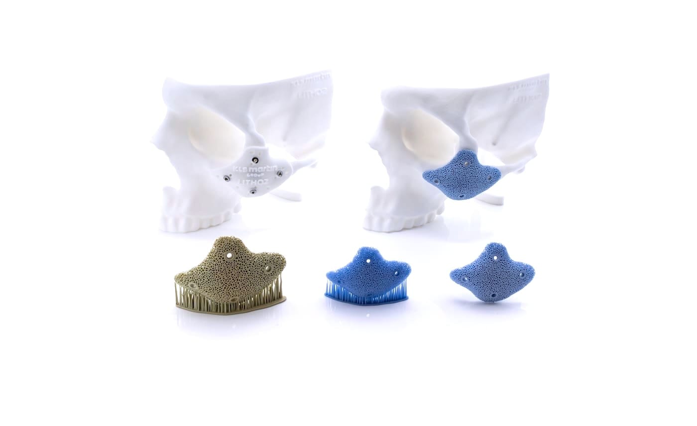 KLS Martin set to deliver 500th LCM 3D printed implant in Q3 2026