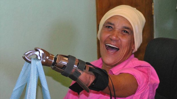 Portland Rotary prosthetics 6.png