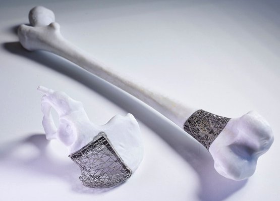 Just in time implants