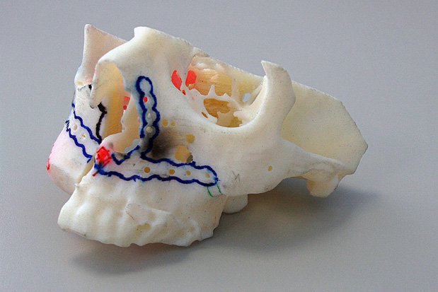 Stratasys medical model Queen Liz Hosp