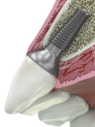 GE Add dental abutment