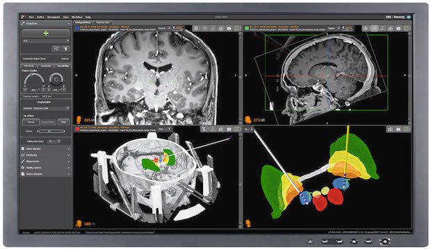 Image 2 Renishaw_neuroinspire_surgical_planning_software.jpg